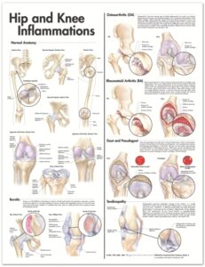 Hip and Knee Inflammations